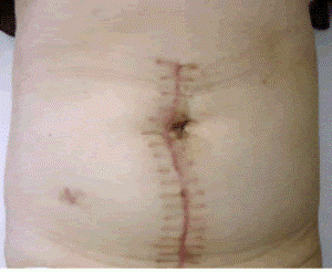 開腹手術後の痕