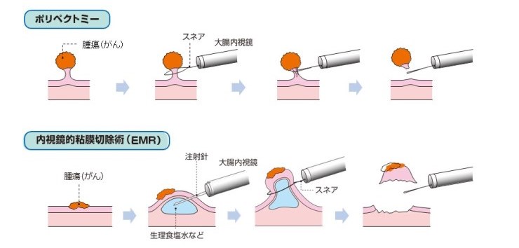 ポリペクトミー、内視鏡的粘膜切除術（EMR）