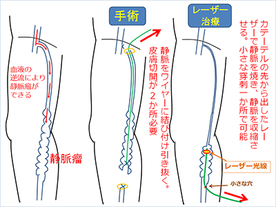 #結紮術についての画像