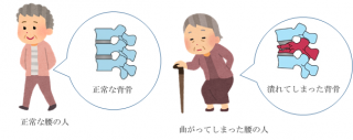 Vol 21 年をとると腰が曲がってしまうのはなぜ 地方独立行政法人 筑後市立病院 Vol 21 年をとると腰が曲がってしまうのはなぜ 地方独立行政法人 筑後市立病院