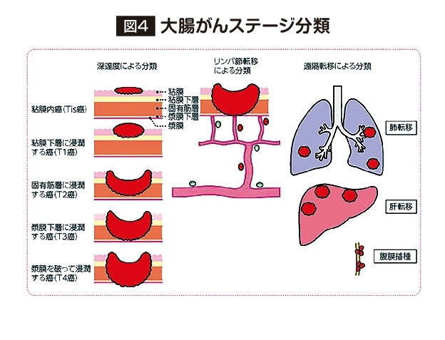 大腸がんステージ分類