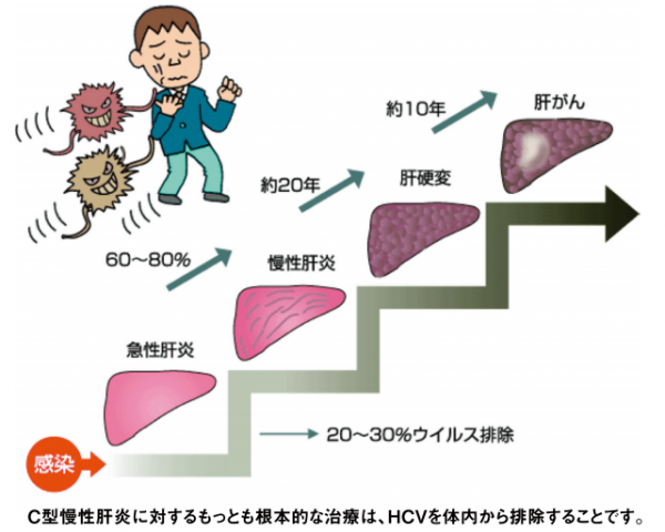 C型慢性肝炎に対するもっとも根本的な治療は、HCVを体内から排除することです。