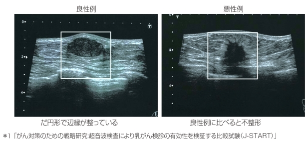 乳腺エコー良性例と悪性例画像