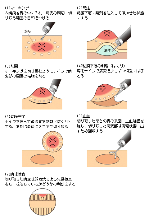 内視鏡的粘膜下層剥離術