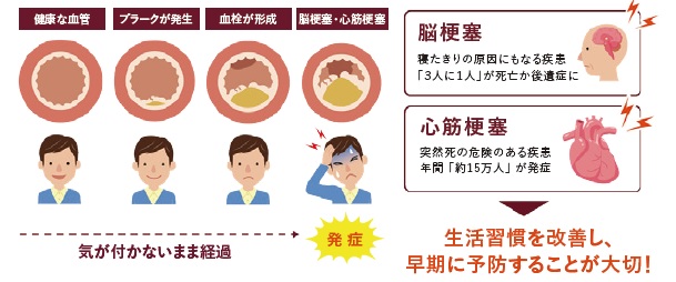 動脈硬化についての図