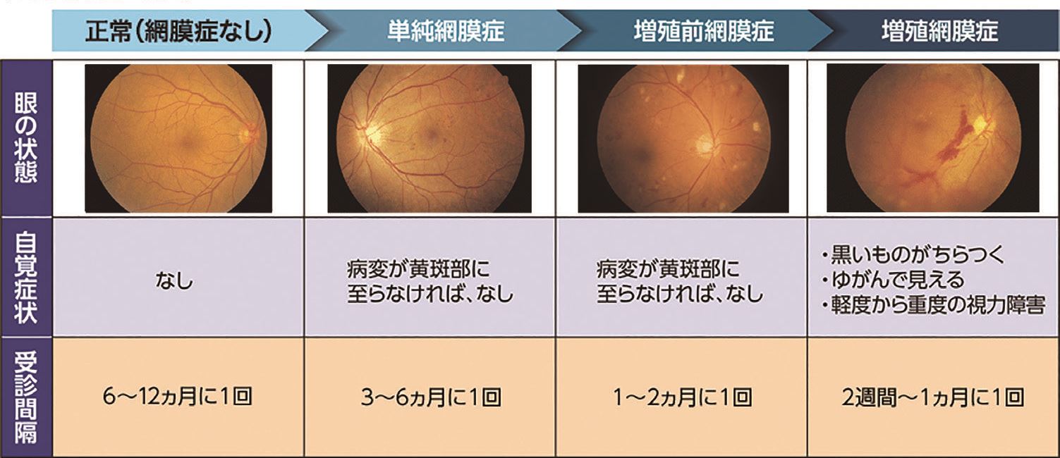 糖尿病網膜症の進み方の画像