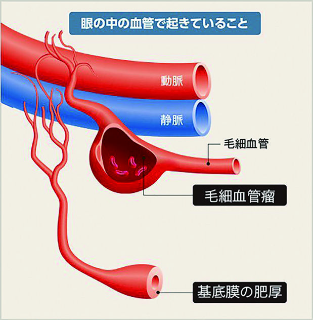 眼の中の血管で起きていることイラスト