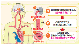 血栓閉塞症の仕組み