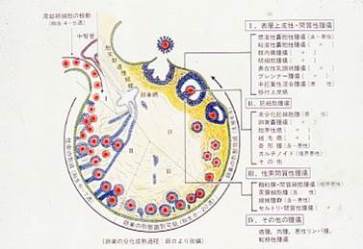 卵巣にできる腫瘍の種類（従来の分類）