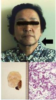 男性型多毛を発症した女性