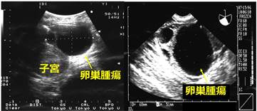 経腹超音波像・経腔超音波像