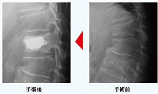 圧迫骨折、術前術後の写真