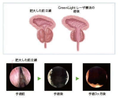 手術前後の前立腺の写真