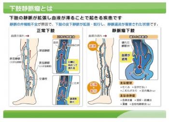 下肢静脈瘤とはの図