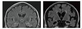 頭部MRI検査
