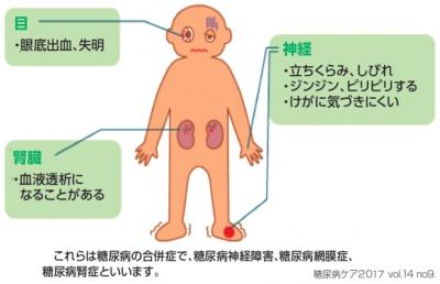 糖尿病三大合併症説明イラスト