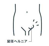 そけいヘルニアのイラスト
