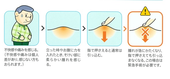 そけいヘルニアの症状