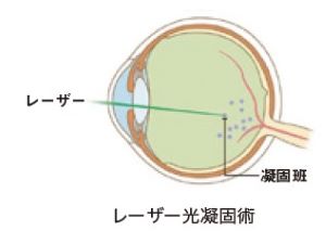 レーザー光凝固術