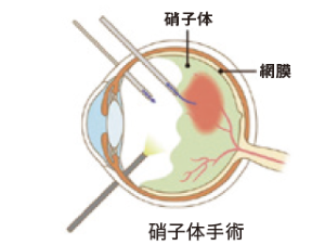 硝子体手術