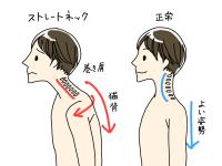 ストレートネックの画像