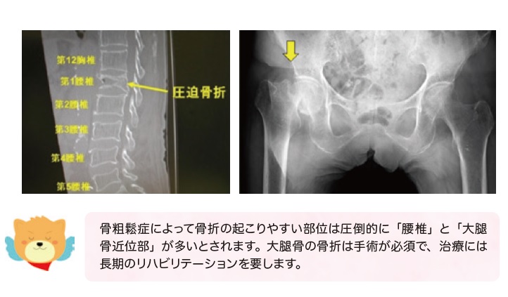 骨粗しょう症の写真 骨粗しょう症の写真