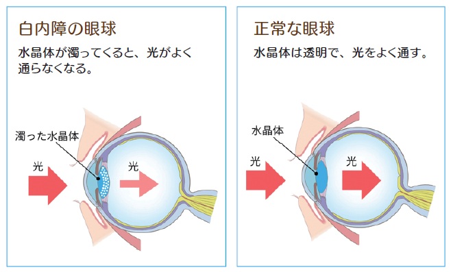 白内障画像